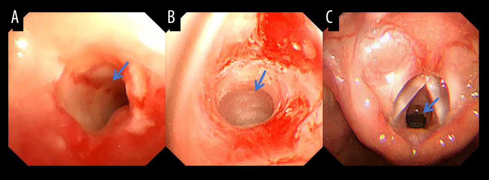 (A) Bronchoscopy on postoperative day 4 and (B) 2 weeks later revealed clinically significant improvement in airway patency. (C) One month postoperatively, fiber laryngoscopy showed complete resolution of stenosis