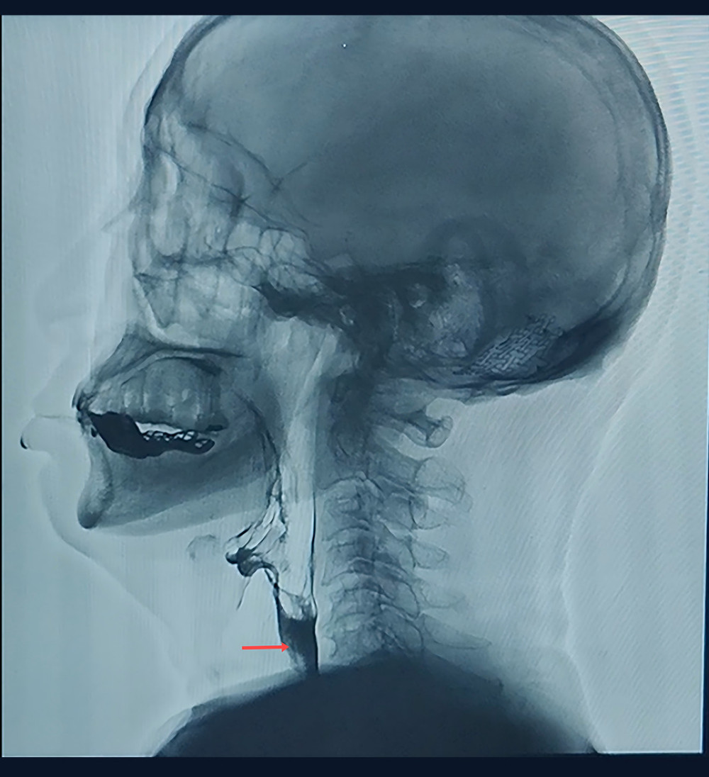Before treatment, the cricopharyngeus muscle was not open (red arrow) and the bolus could not pass down.