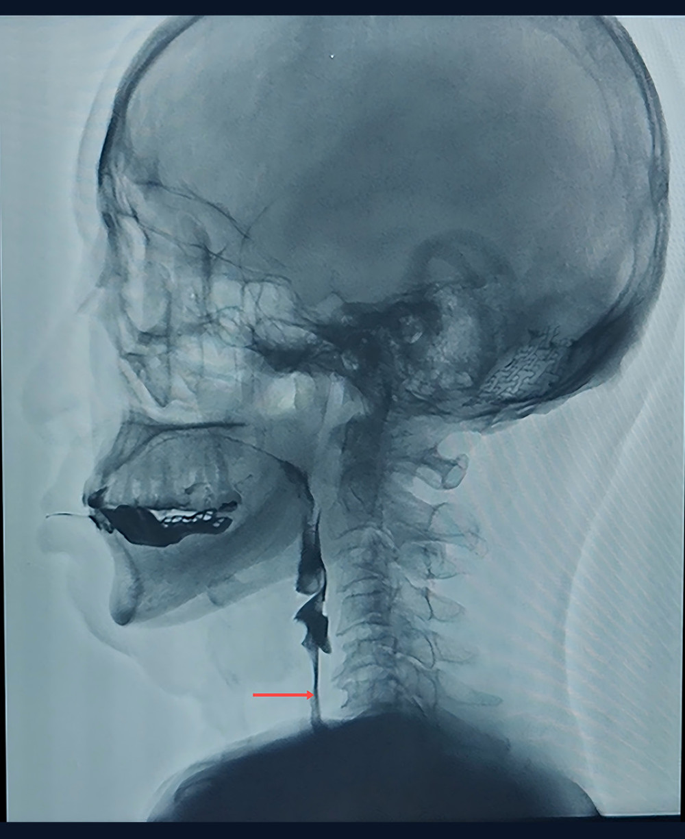 After treatment, the cricopharyngeus muscle was open (red arrow) and the bolus could pass smoothly.
