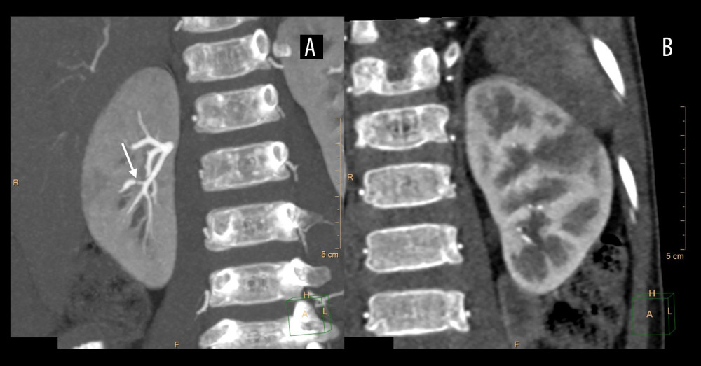 CT angiography of the abdomen. A stenosis of the lower branch of the right renal artery (A, →) and hypodense areas in the left kidney (B).