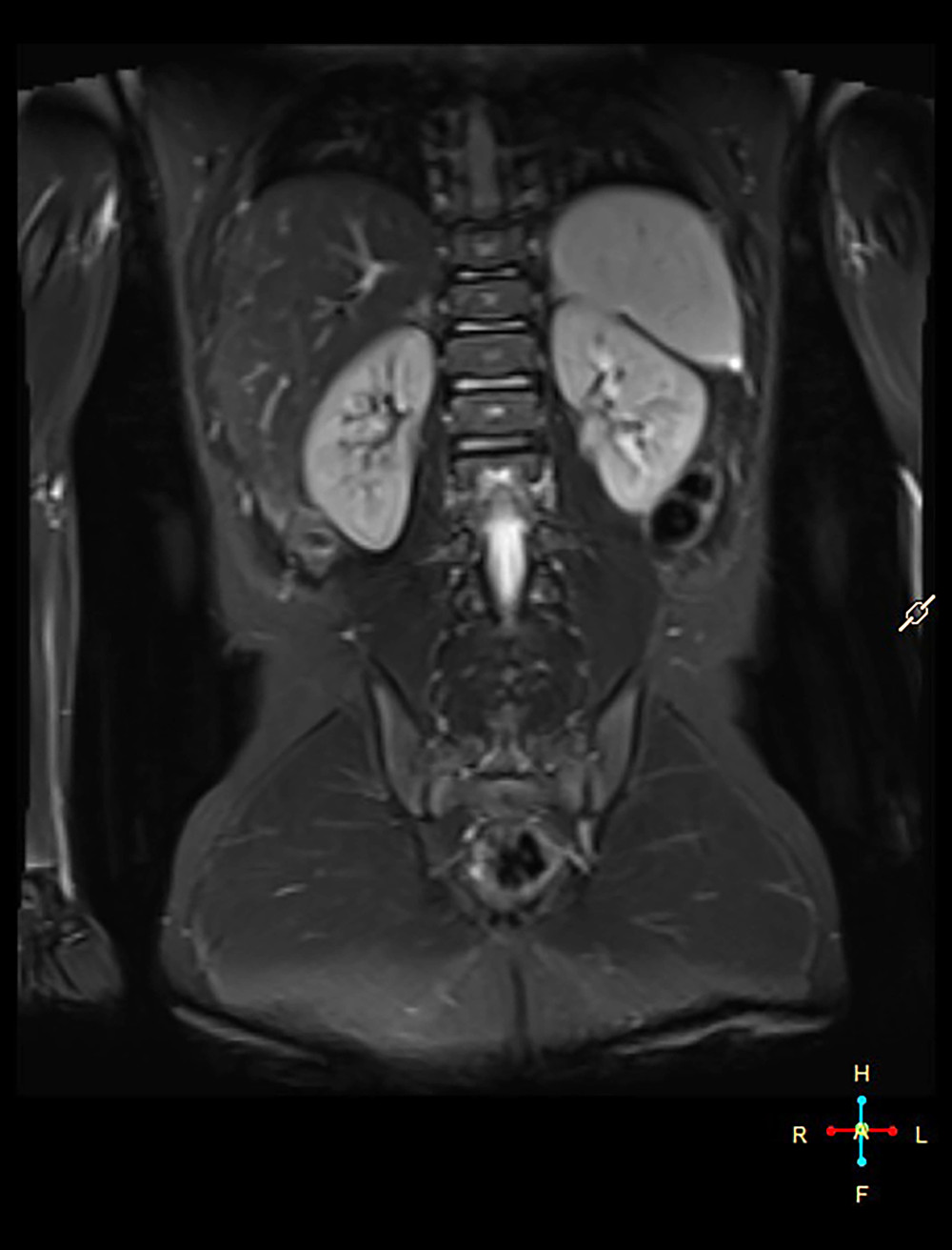 MRI of the abdomen. No abnormalities within the left kidney.