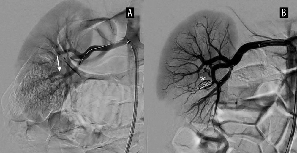 Arteriography. Significant focal narrowing of the proximal aspect of a segmental artery (→), branch arising from the lower division of the right renal artery (A). Coils occluding the narrowed vessel (B, *).