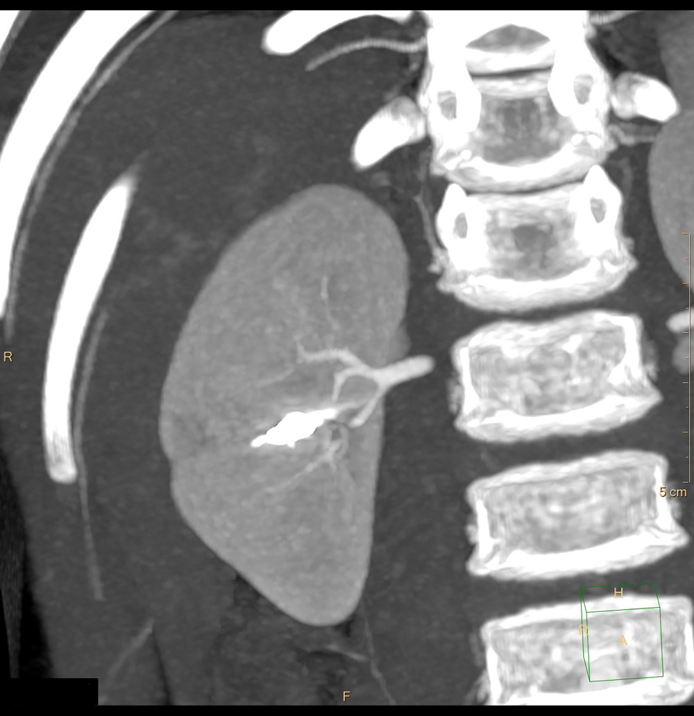 Follow-up CT angiography 4 years after coiling.