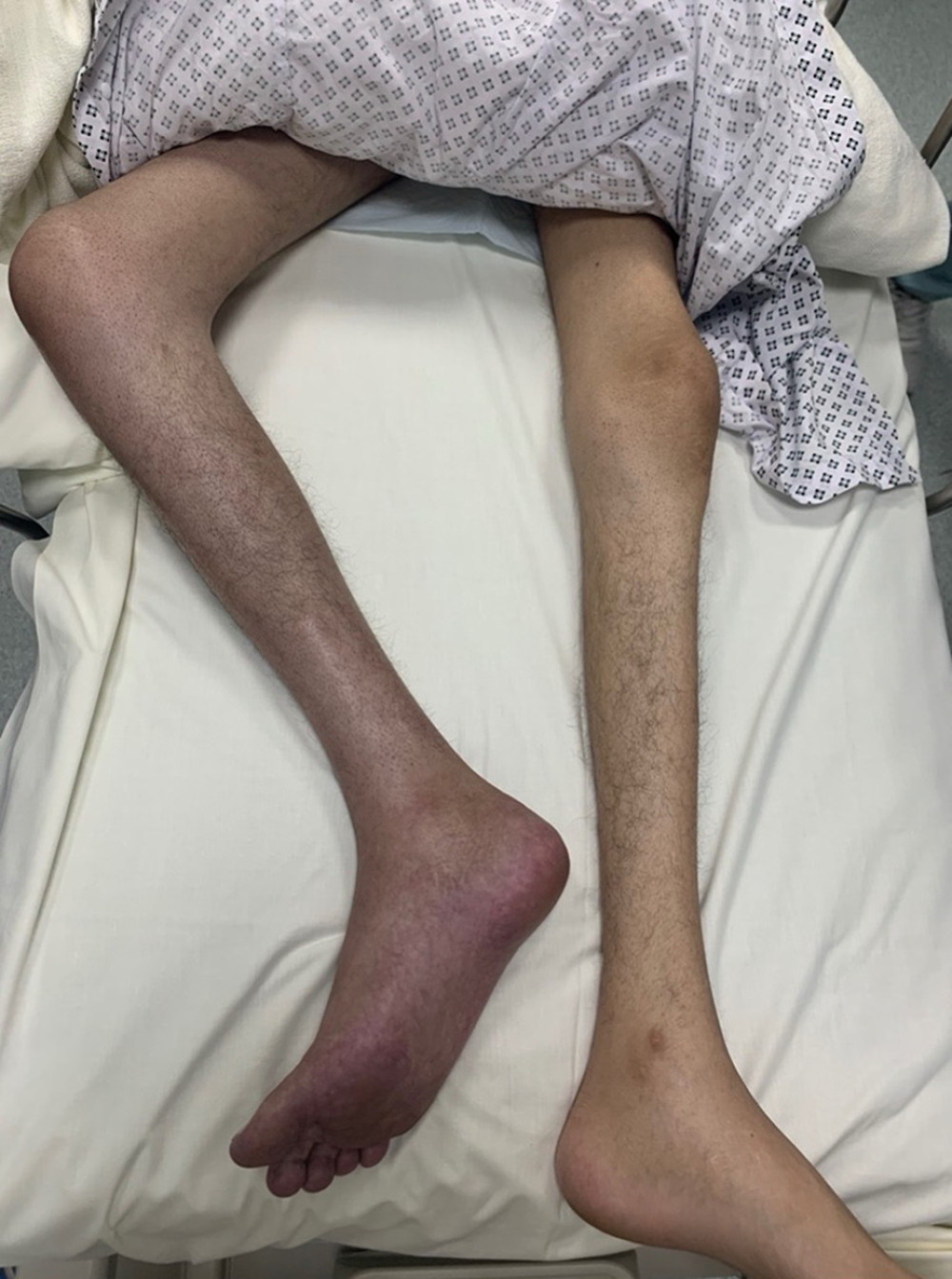 Right lower limb swelling and blue discoloration.
