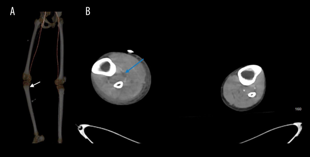 Computed tomography imaging demonstrating progressive non-opacification of the right infrageniculate arteries. (A) Lower limb computed tomography angiography revealing progressive non-opacification of the right infrageniculate arteries with distal loss of opacification (white arrow). (B) Abdominopelvic computed tomography (cross-sectional view) showing progressive non-opacification of the right infrageniculate arteries (blue arrow).