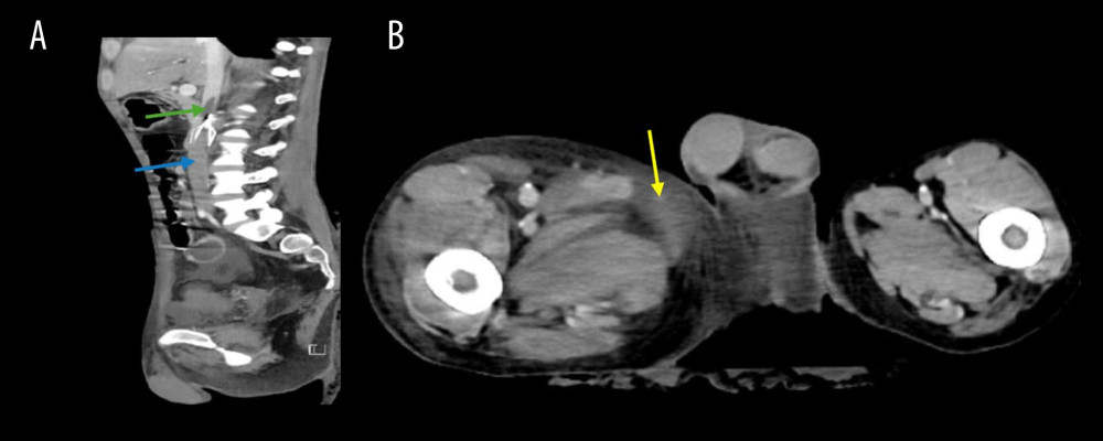 Abdominopelvic computed tomography imaging demonstrating venous thrombosis and associated soft tissue changes. (A) Abdominopelvic computed tomography (sagittal view) showing venous thrombosis extending above the inferior vena cava (IVC) filter (green arrow) into the infrahepatic segment (blue arrow). The IVC filter is visible immediately below the green arrow but not separately labeled. (B) Abdominopelvic computed tomography (cross-sectional view) showing asymmetrical soft tissue enlargement and congestion in the right thigh (yellow arrow).