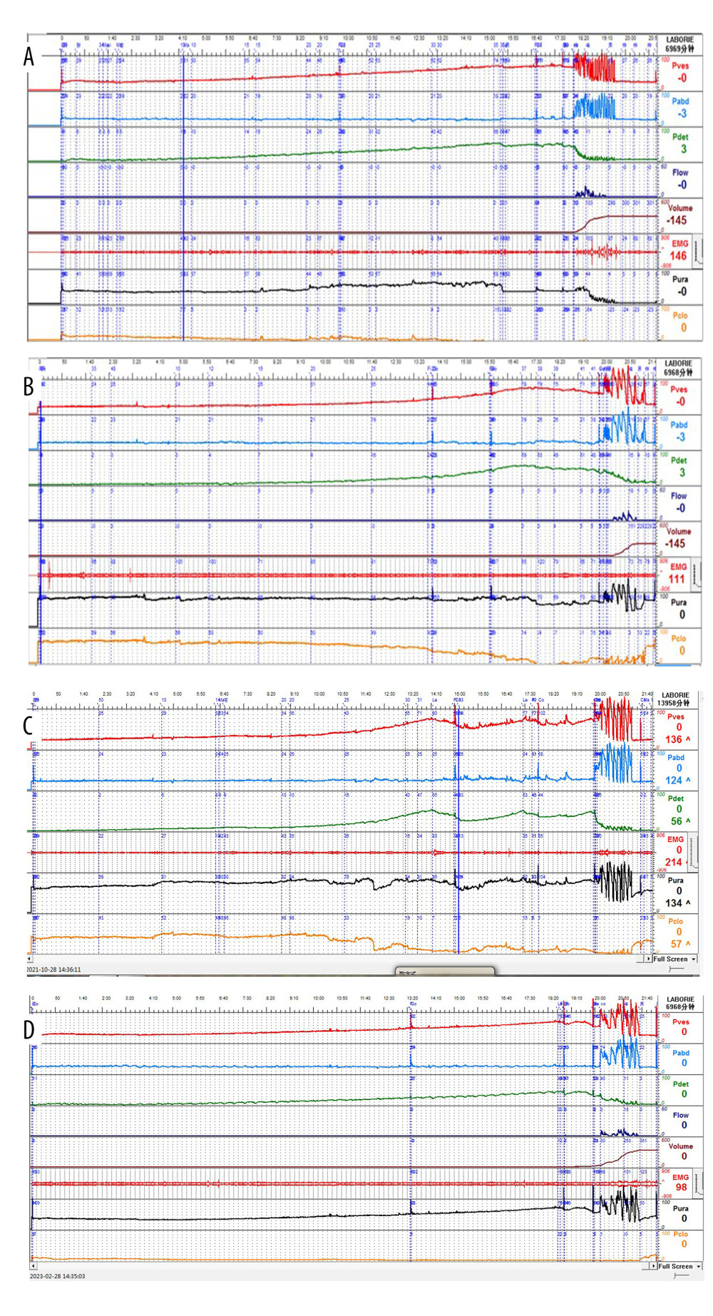 VUDS curve: Pre-operation (C=6.48 ml/cmH2O) (A), 4 months after operation (B), 1 year after operation (C), and 2.5 years after operation (C=8.04 ml/cmH2O) (D)
