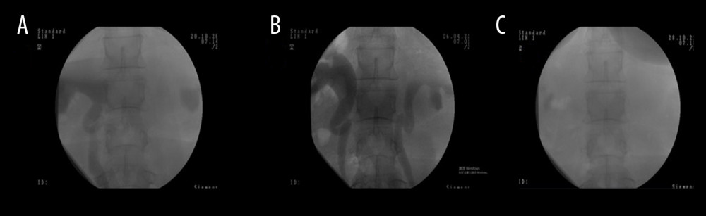 X-ray of the upper urinary tract at the end of voiding phase of VUDS: Pre-operation (A), 4 months after operation (B), and 1 year after operation (C).