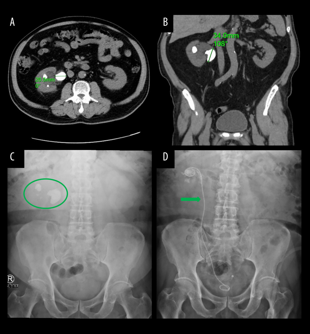 Preoperative imaging findings of right renal and ureteral stones. CT scans: (A) Axial view showing the stone (longest axis marked with green numbers). (B) Coronal view of the right kidney. KUB X-ray: (C) Multiple right renal stones (green circles). (D) Ureteral stent placement (green arrow).
