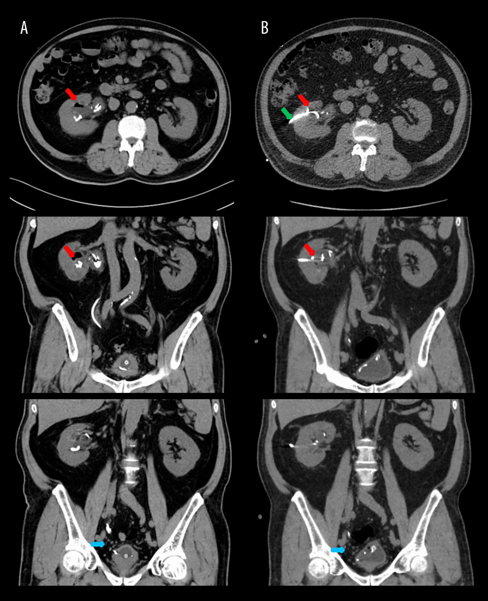 Imaging changes before and after nephrostomy with secondary RIRS. (A) Admission CT scans: (Top) Axial view and (Middle) coronal view demonstrating right pneumopyelia (red arrows), (Bottom) coronal view showing mid-right ureteral steinstrasse. (B) Postoperative CT scans: (Top) Axial view and (Middle) coronal view revealing resolution of pneumopyelia (red arrows) and nephrostomy tube placement (green arrow), (Bottom) coronal view confirming complete clearance of ureteral steinstrasse.