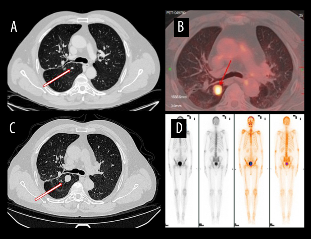 Chest imaging workup of the right upper lobe nodule(A) Computed tomography (CT) from August 2024 shows a 0.7-cm, smooth-edged subpleural nodule. (B) CT from January 2025 demonstrates interval growth to 1.7 cm. (C) Positron-emission tomography/CT reveals increased uptake (SUVmax 5.2). (D) Whole-body bone scintigraphy shows no skeletal uptake, providing evidence against a bone primary or osseous metastasis.