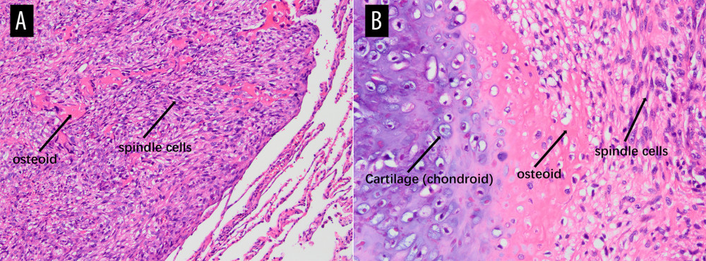 Histopathology of primary pulmonary osteosarcoma with hematoxylin and eosin staining(A) Magnification ×100. Low-power view of a hypercellular spindle-cell neoplasm within lung parenchyma, with irregular dense eosinophilic osteoid deposits (arrow named “osteoid”) rimmed and permeated by tumor cells (labeled “spindle cells”). Residual alveolar septa/fibrous stroma are present at the periphery, indicating adjacency to native lung. (B) Magnification ×200. Higher-power view demonstrates a triphasic pattern with focal chondroid differentiation (labeled “Cartilage, chondroid”) showing basophilic matrix containing lacunae with chondrocyte-like tumor cells, transitioning to abundant lace-like/trabecular eosinophilic osteoid (labeled “osteoid”). The osteoid is directly produced by and rimmed and permeated by atypical spindle tumor cells (labeled “spindle cells”), exhibiting nuclear pleomorphism, hyperchromasia, and frequent mitotic figures. The intimate association of malignant spindle cells with tumor osteoid, together with focal chondroid differentiation, supports an osteoid-forming high-grade sarcoma (osteoblastic osteosarcoma phenotype).