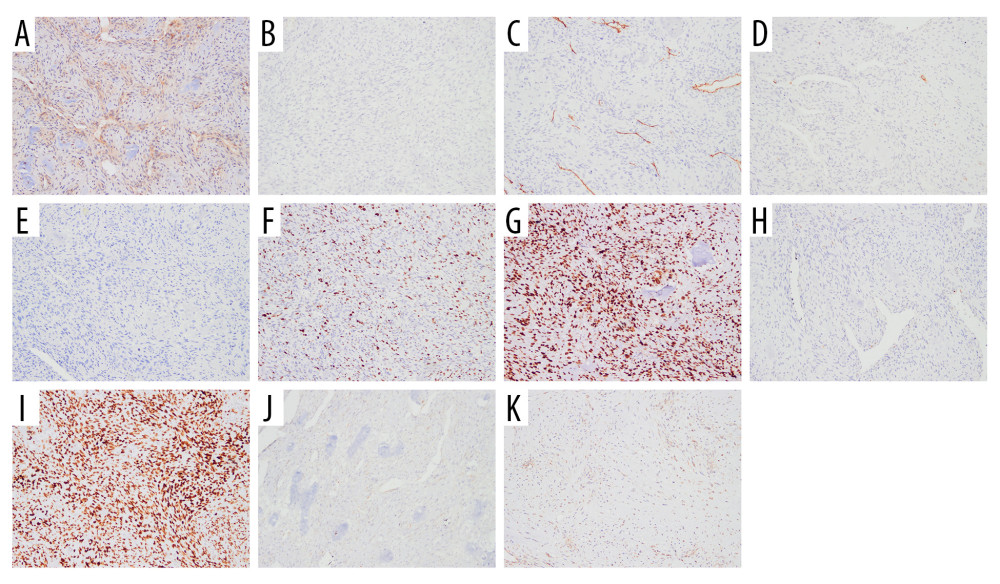 Immunohistochemical panel of the tumor (all with magnification ×100)(A) B-cell lymphoma 2 (BCL-2): focal positivity. (B) Low-molecular-weight cytokeratin antibody CK8/18 (CAM5.2): negative (rare weak-positive cells). (C) CD34: restricted to vascular endothelium (internal control). (D) Cytokeratin: negative (rare weak-positive cells). (E) Desmin: negative. (F) Ki-67 proliferation: approximately 30% labeling index. (G) Tumor suppressor protein (p53): diffuse strong nuclear staining (mutant-type pattern). (H) S100 protein family: focal positivity. (I) Special AT-rich sequence-binding protein 2 (SATB2): diffuse nuclear positivity. (J) Smooth muscle actin (SMA): focal positivity. (K) Signal transducer and activator of transcription 6 (STAT6): negative. Epithelial membrane antigen (not shown) was also negative. The overall IHC profile supports osteoblastic differentiation and argues against epithelial, vascular, and solitary fibrous tumor lineages.