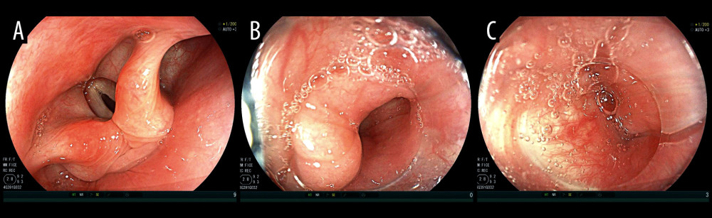 (A) Panoramic view of the pharynx, no foreign bodies detected. (B) Right pyriform fossa, no foreign bodies detected. (C) Left pyriform fossa, no foreign bodies detected.