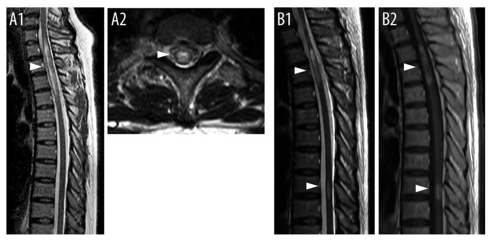 Magnetic resonance imaging of the spinal cord at onset and relapse. (A) T2-weighted sagittal image of the spinal cord showing a high-intensity lesion extending from Th1 to Th5 (A1); T2-weighted axial view at the Th2/3 level, demonstrating a prominent high-intensity lesion in the ventral cord (A2). (B) T2-weighted sagittal image of the thoracic cord showing lesions at the Th3–4 and Th10 levels (B1), with gadolinium enhancement (B2). Arrowheads indicate the lesions.