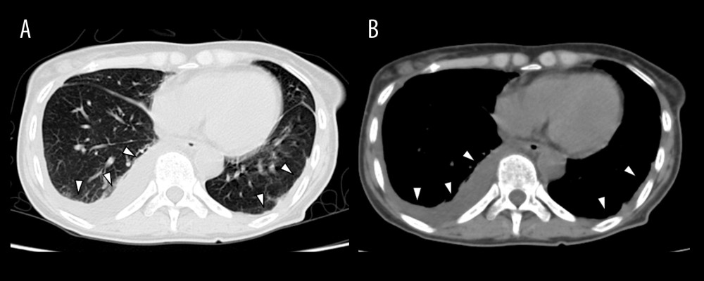 Chest computed tomography showing bilateral pleural effusions and pleural thickening. Axial chest computed tomography demonstrates bilateral pleural effusions and pleural thickening. Arrowheads indicate pleural abnormalities.