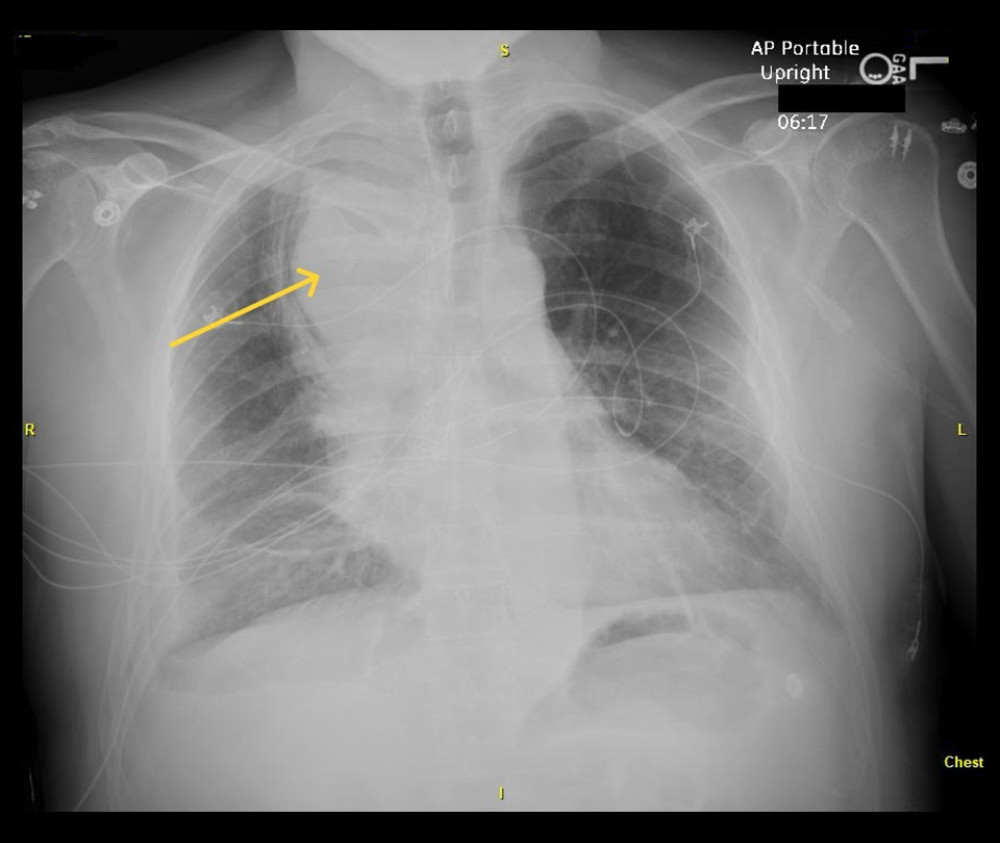 Chest X-ray showing widening of mediastinum (arrow).