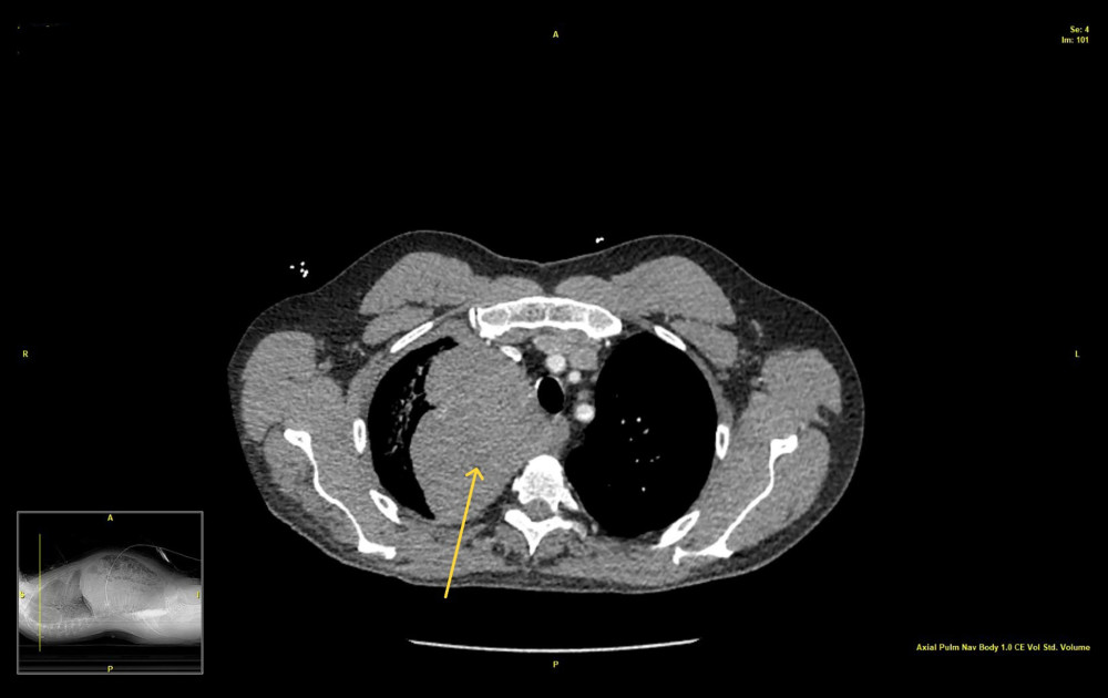 CT chest axial view showing mediastinal hematoma (arrow).