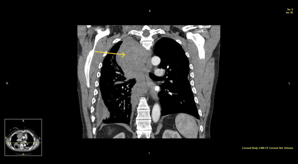 CT chest coronal view showing mediastinal hematoma (arrow).