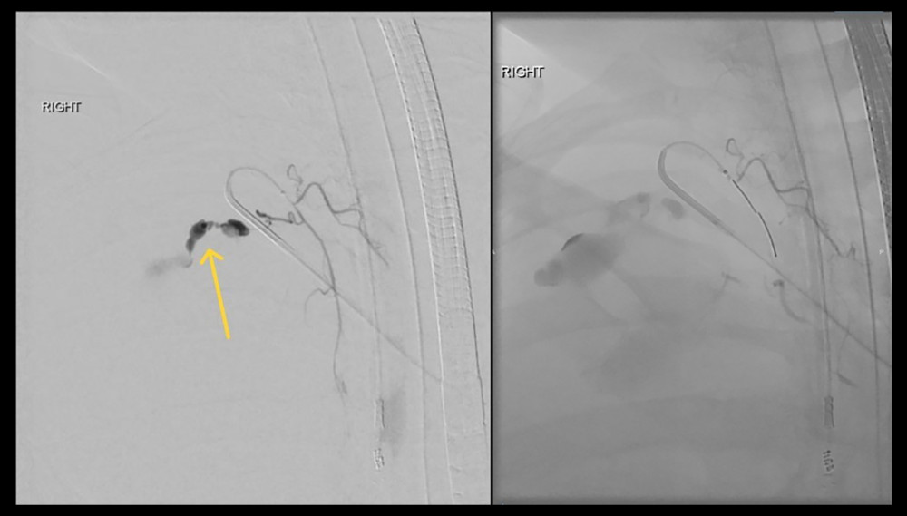 Angiogram showing bleeding from right second intercostal artery (left) and after embolization (right).
