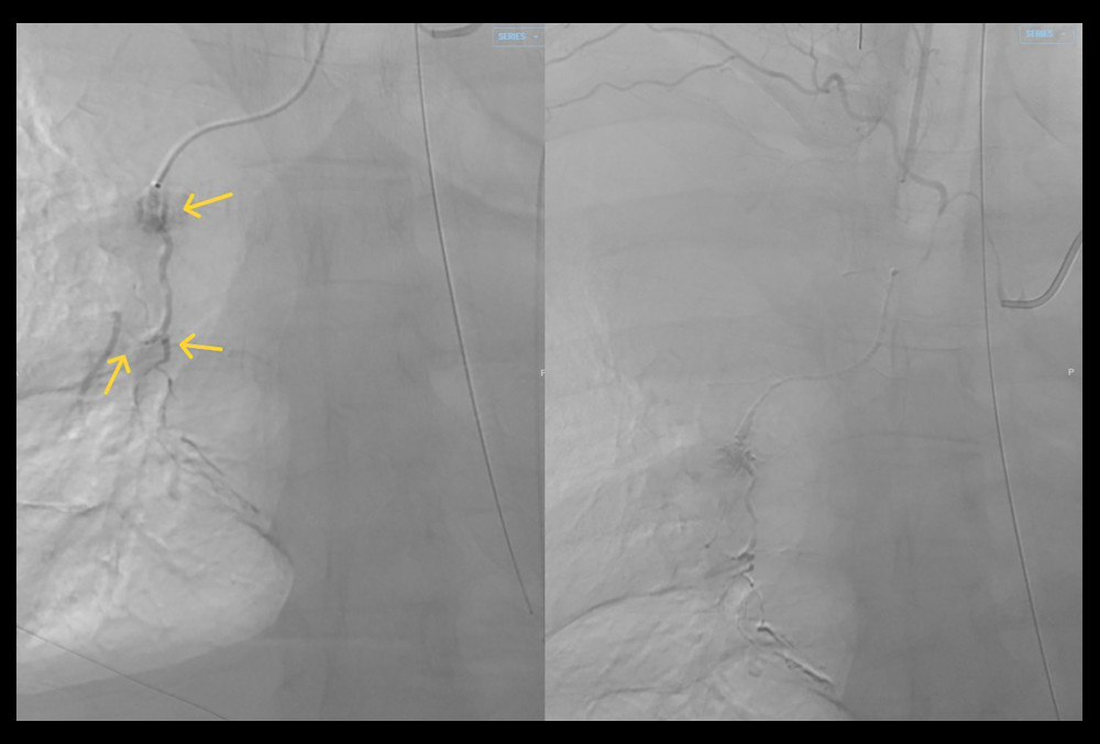 Right bronchial artery angiogram showing an irregular segment (arrow, left) and after embolization (right).