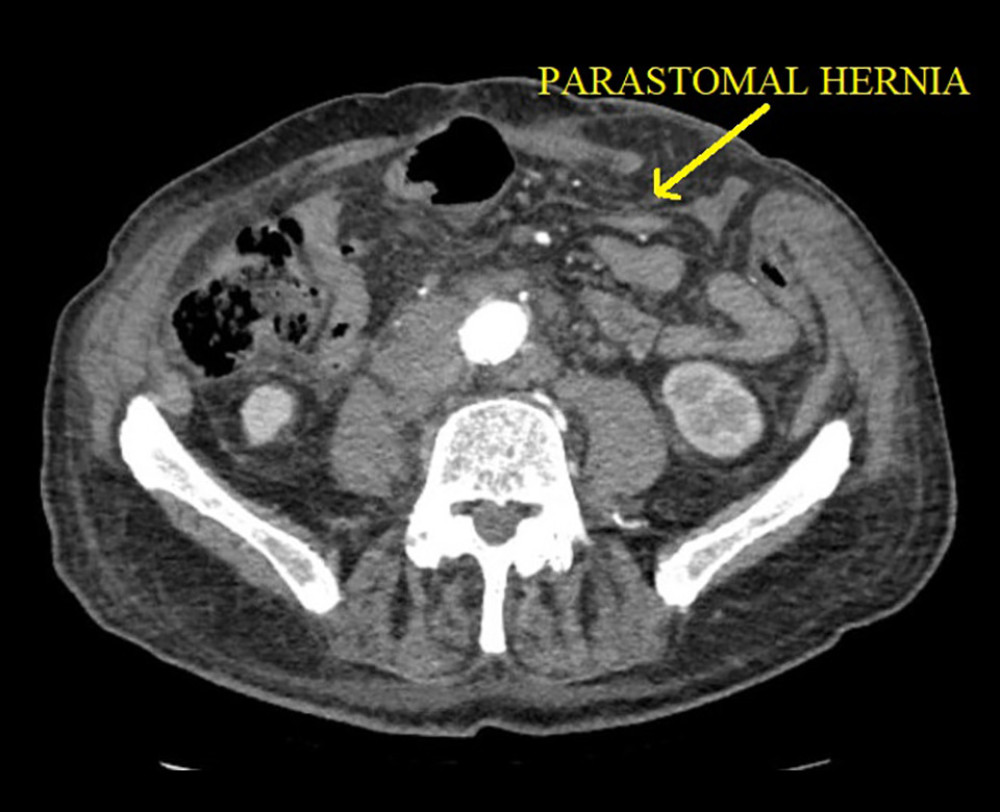 Parastomal hernia on CT scan 1 month before evisceration.