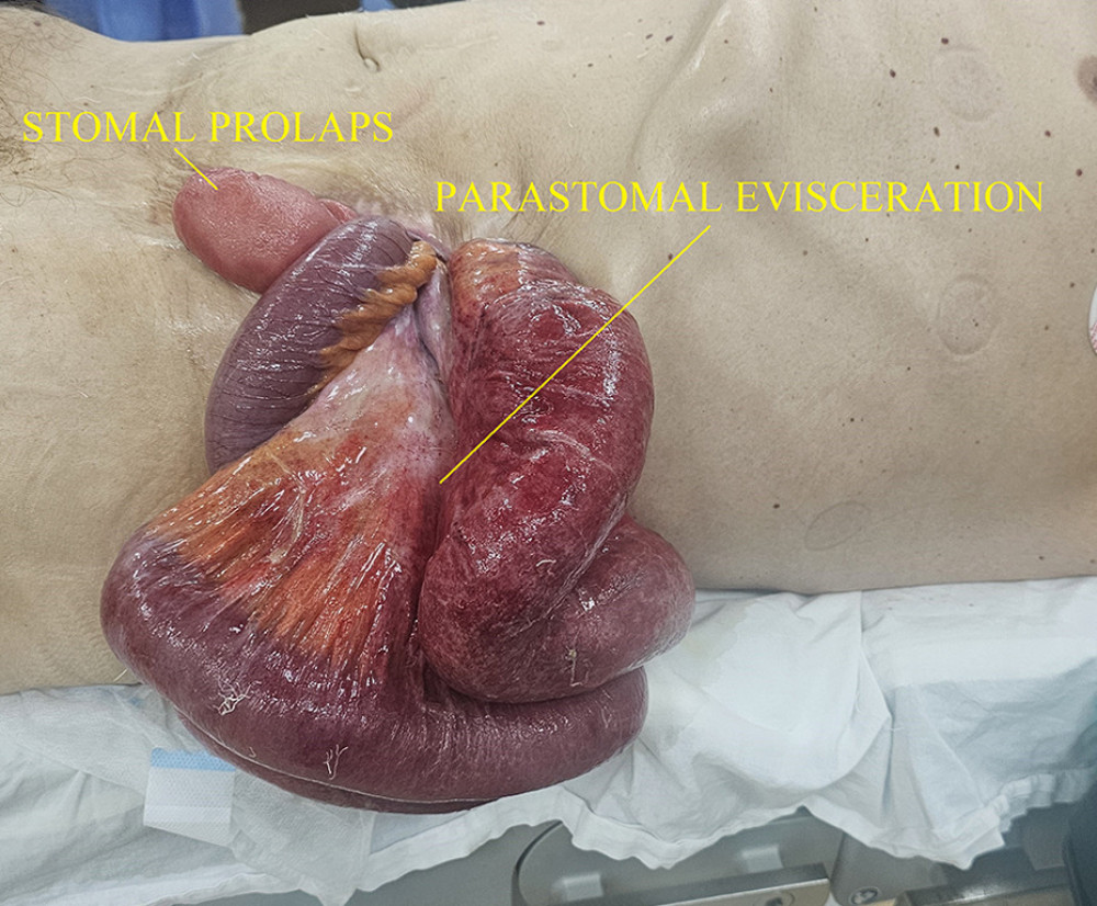 Clinical appearance just before surgery. Note the aspect of ischemia of the intestinal loops.
