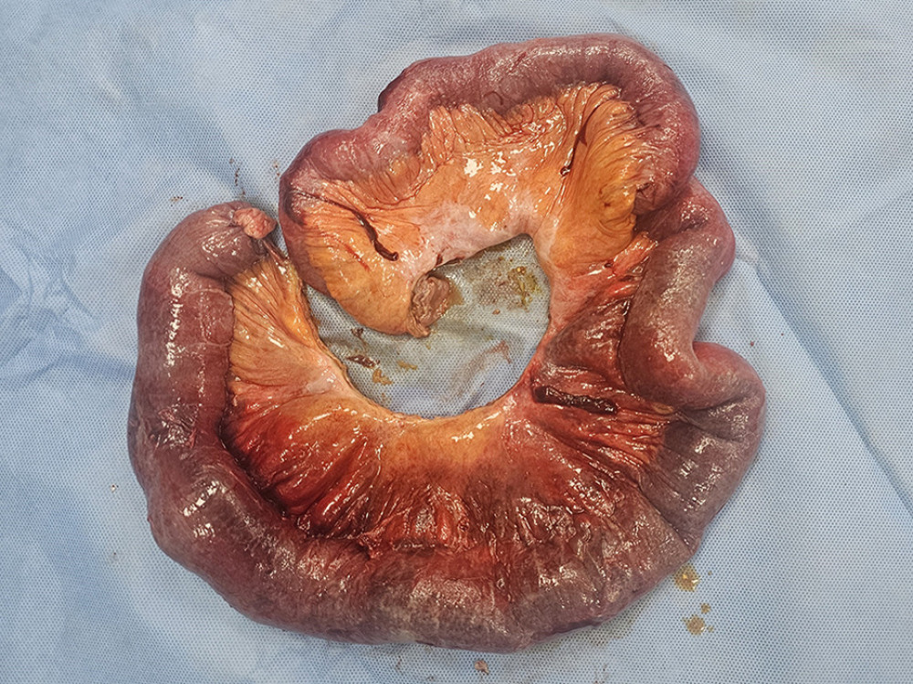 Excised bowel loops.