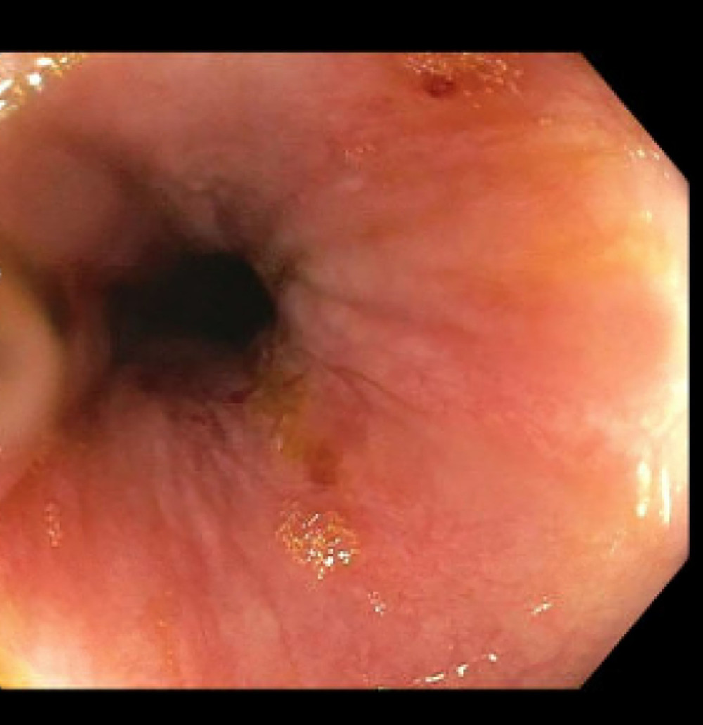 LA grade D esophagitis.