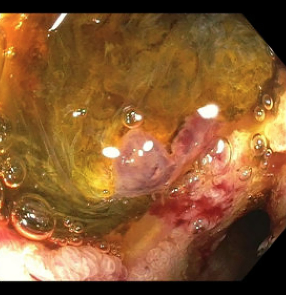 Two oozing, cratered ulcers in the duodenal bulb.