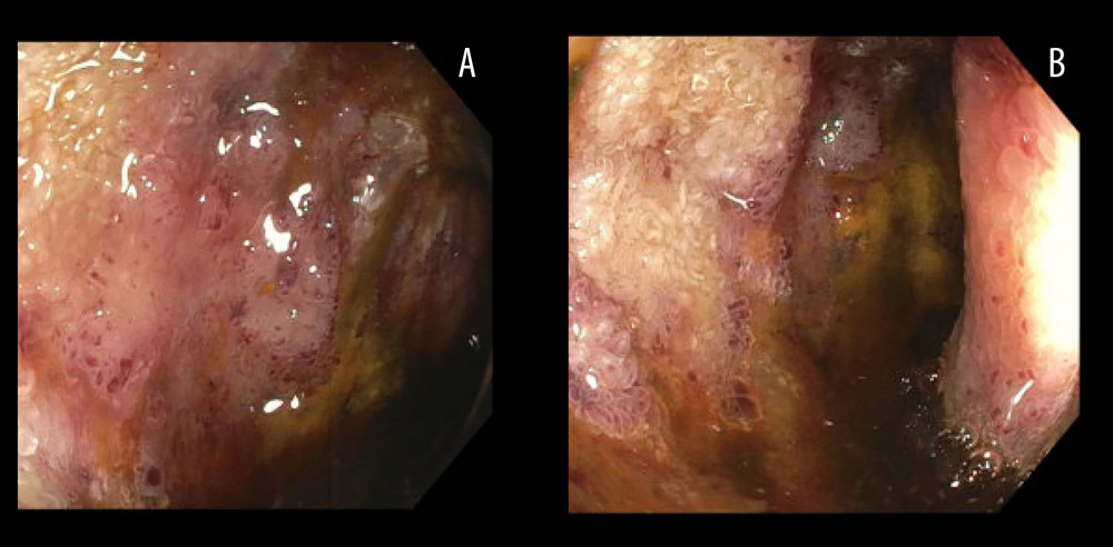 (A, B) Diffuse mucosal changes characterized by congestion, discoloration, and erythema in the jejunum.
