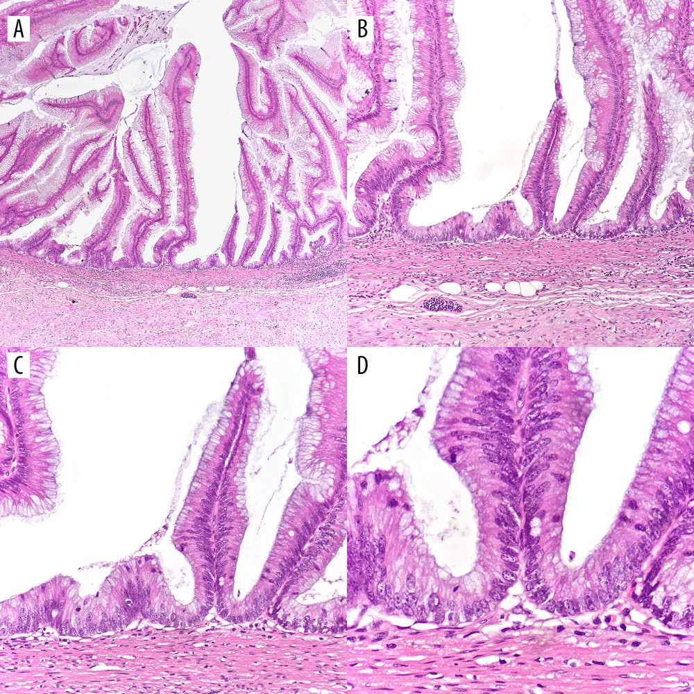 (A–D) Low-grade appendiceal mucinous neoplasm (LAMN). (A–C) Proliferation of mucinous epithelial cells forming villous structures within the appendiceal lumen. The underlying lymphoid tissue is atrophic, and the muscularis mucosae is effaced. Subepithelial fibrosis is present, and the lesion demonstrates a pushing (non-infiltrative) growth pattern. (D) The lesional epithelium shows abundant apical mucin and elongated nuclei with mild (low-grade) cytologic atypia. (H&E; magnifications: A ×40; B ×100; C ×200; D ×400).
