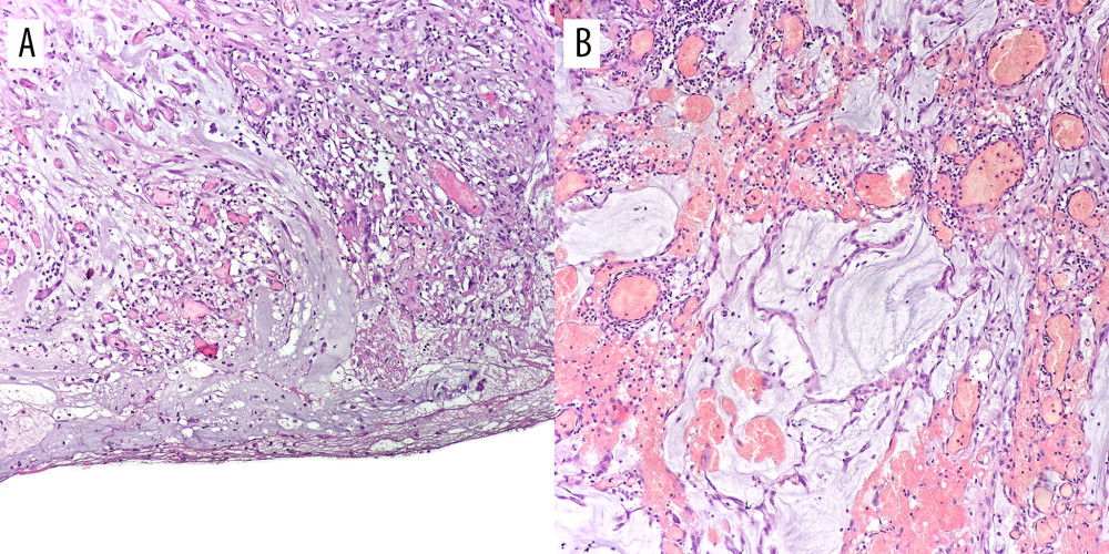 (A, B) Extruded mucin. (A) Mucin pools covering the serosa with a prominent granulation tissue response. (B) Extruded mucin surrounded by granulation tissue composed of fibroblasts, blood vessels and inflammatory cells. (H&E; magnifications: ×100).