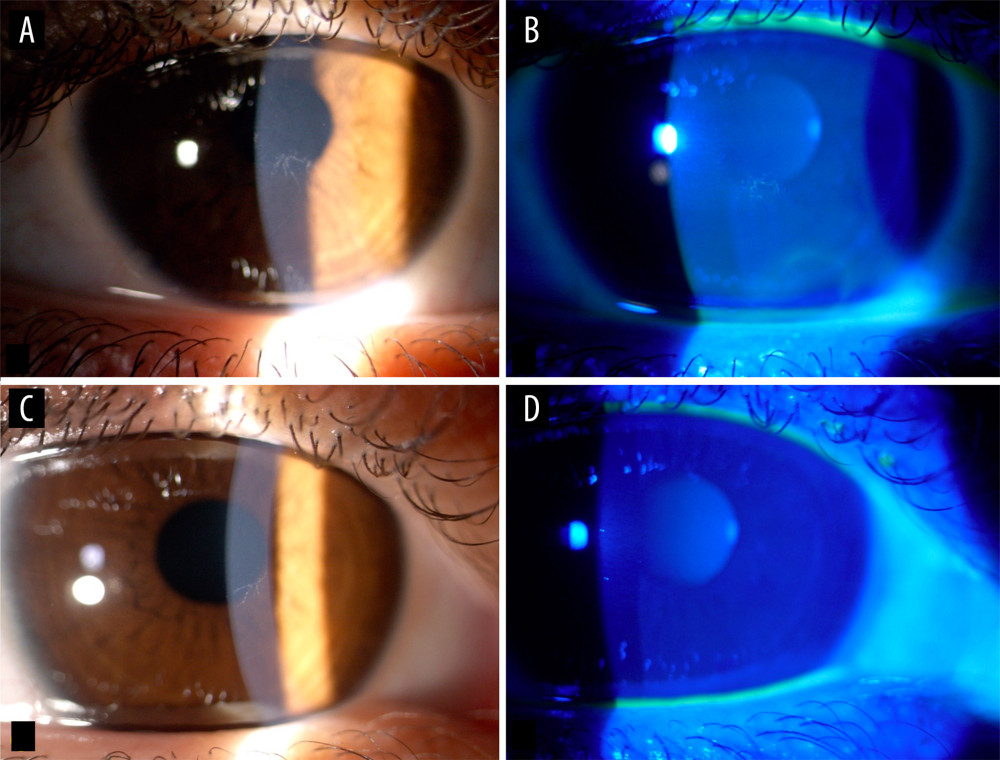 From left to right: (A) Right eye baseline examination: central epithelial pseudodendritic lesion, which (B) stained with fluorescein. (C) Left eye baseline examination: central epithelial pseudodentritic lesion which (D) faintly stained with fluorescein.
