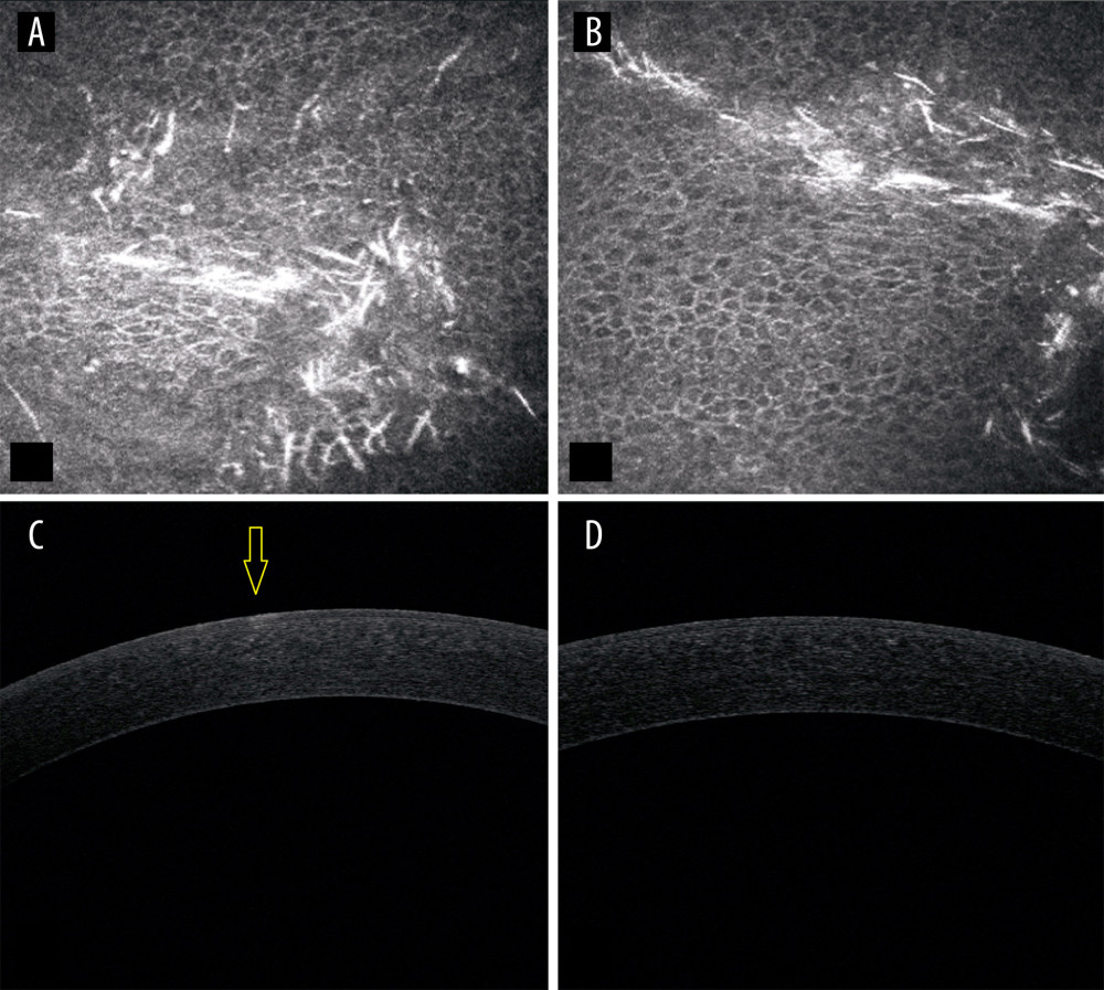 From left to right: (A) Right eye in vivo confocal microscopy (IVCM) baseline epithelial lesion. (B) Left eye IVCM baseline epithelial lesion (C) Right eye baseline anterior segment optical coherence tomography (AS-OCT) showing the lesion. (D) Left eye AS-OCT baseline without evidence of the lesion.