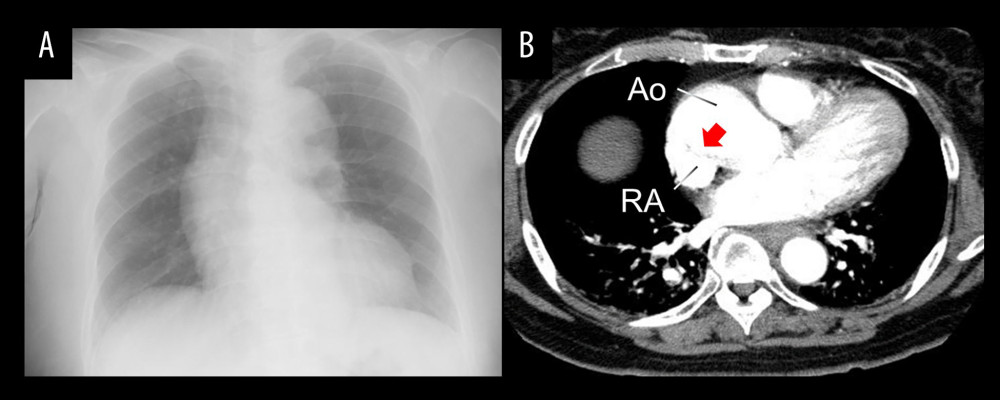 Chest imaging findings. (A) Chest X-ray showing mild cardiomegaly and dilation of the right pulmonary hilum. (B) Contrast-enhanced chest CT scan demonstrating compression of the right atrium by an enlarged ascending aorta (red arrow). CT – computed tomography; Ao – aorta; RA – right atrium.