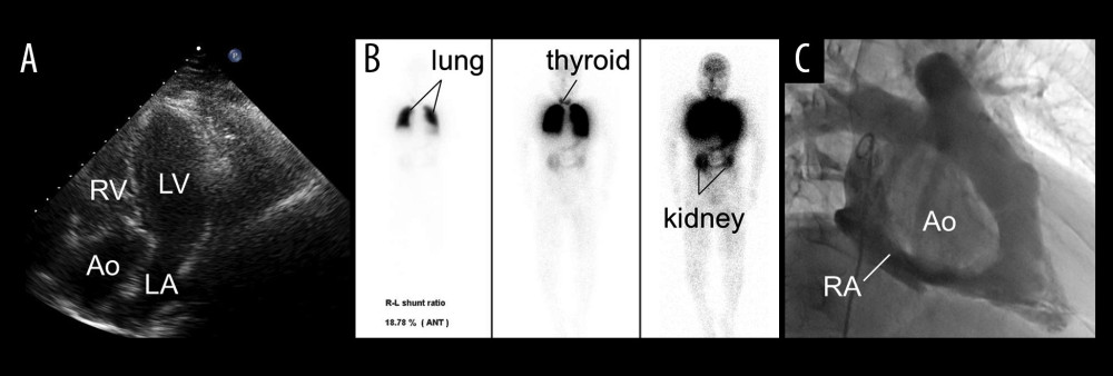 Cardiac and scintigraphic findings. (A) Apical 4-chamber view on transthoracic echocardiography showing an enlarged aortic root (Ao) obscuring visualization of the right atrium, tricuspid valve, and interatrial septum, where a shunt would usually be identified. (B) Lung perfusion scintigraphy demonstrating technetium-99m (99mTc) particle uptake in the thyroid (middle) and kidneys (right) in addition to the lungs (left), indicating systemic distribution due to a right-to-left shunt. (C) Right atriography showing compression of the right atrium by the dilated ascending aorta (Ao). 99mTc – technetium-99m-labeled macroaggregated albumin; Ao – aorta; RV – right ventricle; LV – left ventricle; LA – left atrium; RA – right atrium.