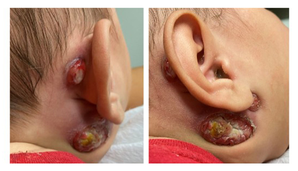 The progressive growth of infra-auricular and right retroauricular cervical mass. The mass measures approximately 2.5×2.0 cm, with phlogosis and drainage point, in addition to ipsilateral suppurative lymphadenitis.