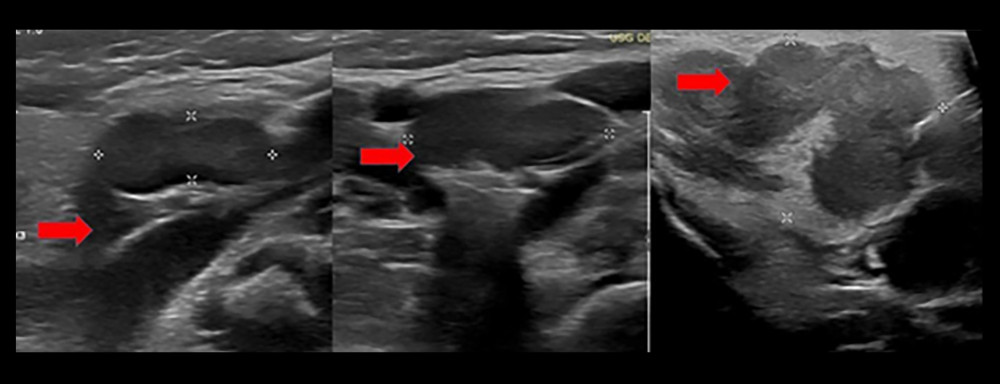 Ultrasound examination showing lymph node enlargement and a lymph node conglomerate at right level II, with loss of hilar architecture, measuring 2.6×1.5 cm in its largest axial dimensions. Additional lymph nodes are increased in number, with some enlarged and loss of fatty hila at right level IB and bilateral levels II, III, and V, predominating on the right.