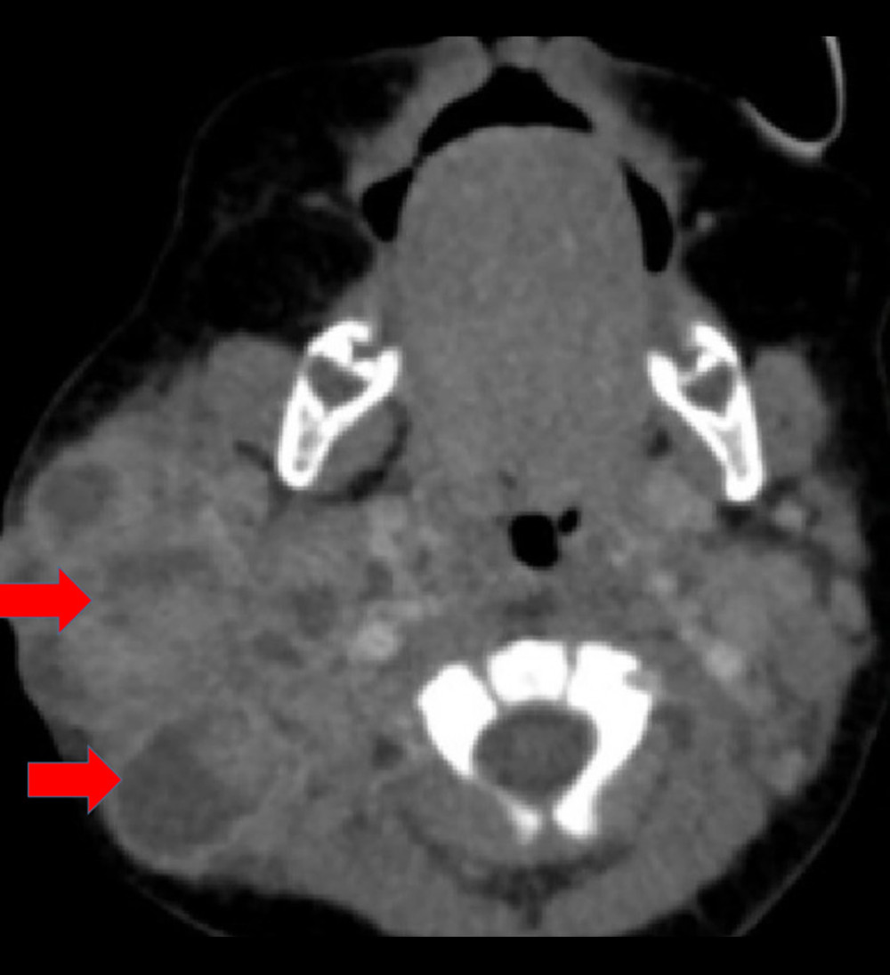 Computed tomography axial scan showing an expansile granulomatous lesion with bone involvement, including the tympanic tegmen, and associated lymph node enlargement.