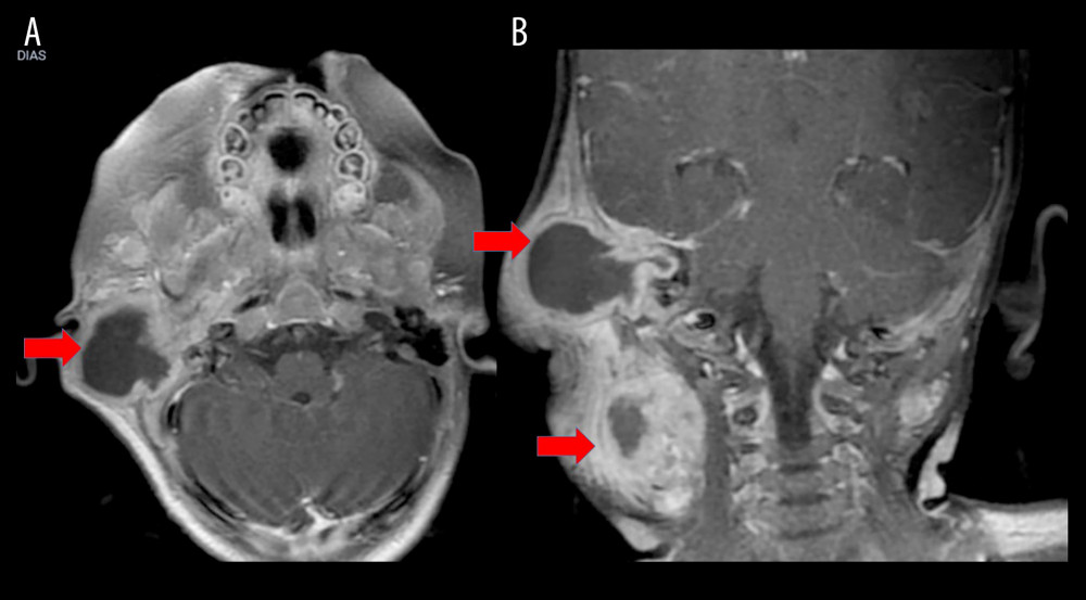 Nuclear magnetic resonance imaging showing an expansive and infiltrative lesion in the right cervical region. There is no involvement of the central nervous system: (A) axial section; (B) coronal section.