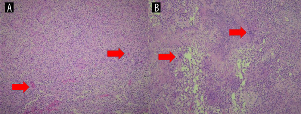 Anatomopathologic examination demonstrates an expansive and infiltrative lesion in the right cervical region. Hematoxylin-eosin-stained sections show histiocytic cells and multiple necrotizing granulomas. (A) Low-power magnification, ×10. (B) Higher-power magnification, ×20.