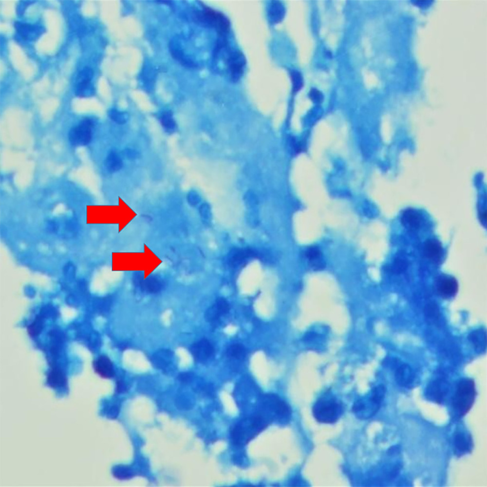 Fite-Faraco staining demonstrating acid-fast bacilli, ×100 magnification.
