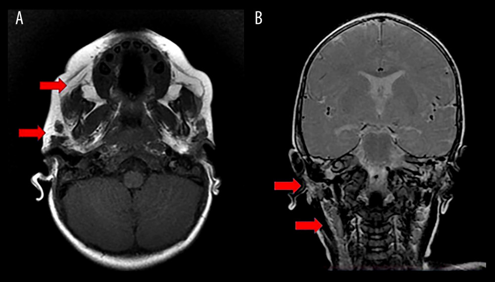 Nuclear magnetic resonance imaging 11 months after treatment with rifampicin, isoniazid, and ethambutol (RIE), showing complete resolution of all lesions and lymph node enlargement. (A) Axial section; (B) coronal section.