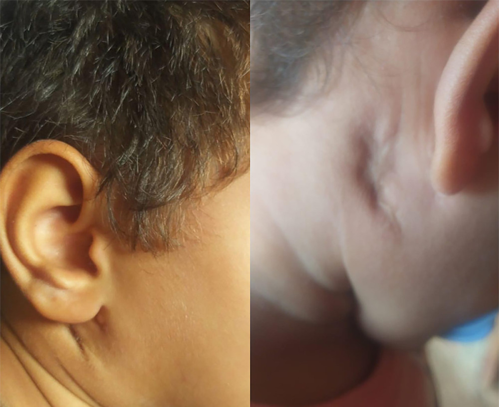 Appearance of the cervical lesion and right ear at last follow-up.