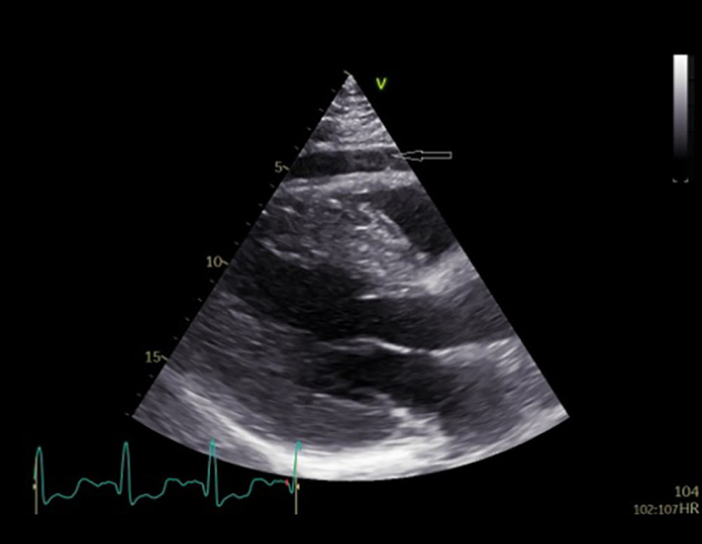 Two-dimensional transthoracic echocardiography. The parasternal long-axis view demonstrates left ventricular hypertrophy and regional pericardial effusion (arrow) anterior to the right ventricle.