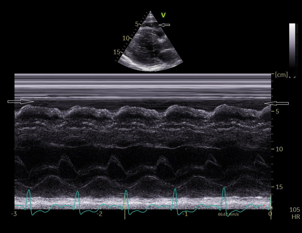 M-mode transthoracic echocardiography. The parasternal long-axis view shows regional pericardial effusion (arrows) anterior to the right ventricle.