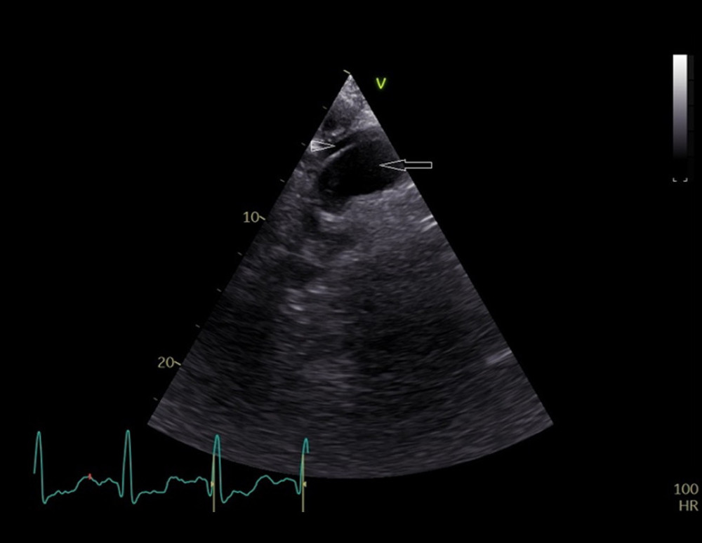 Two-dimensional transthoracic echocardiography. The suprasternal view of the aorta reveals 2 vascular lumina (true [arrow] and false [arrowhead]) separated by an intimal flap, indicative of ascending aortic dissection extending into the proximal aortic arch.