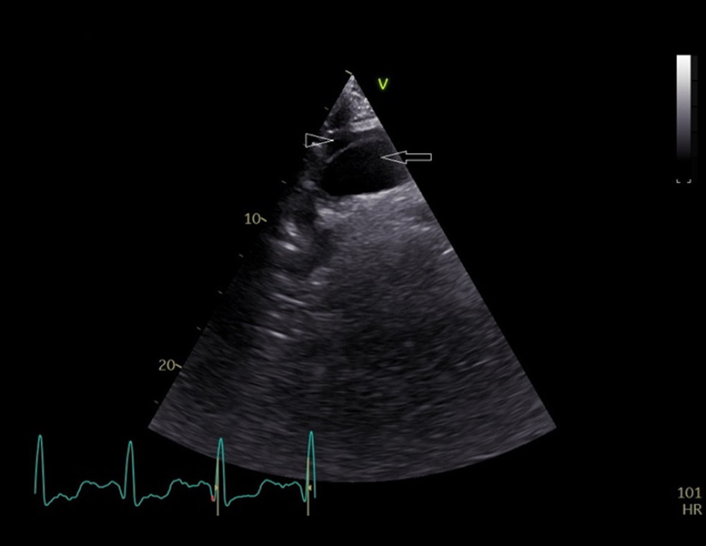 Two-dimensional transthoracic echocardiography. The suprasternal view of the aorta shows 2 vascular lumina (true [arrow] and false [arrowhead]) separated by an intimal flap, indicating an ascending aortic dissection extending into the proximal aortic arch.