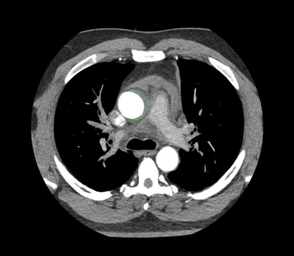 Contrast-enhanced computed tomography with axial reconstruction suggestive of Stanford Type A acute aortic dissection (gray region inside the green line).